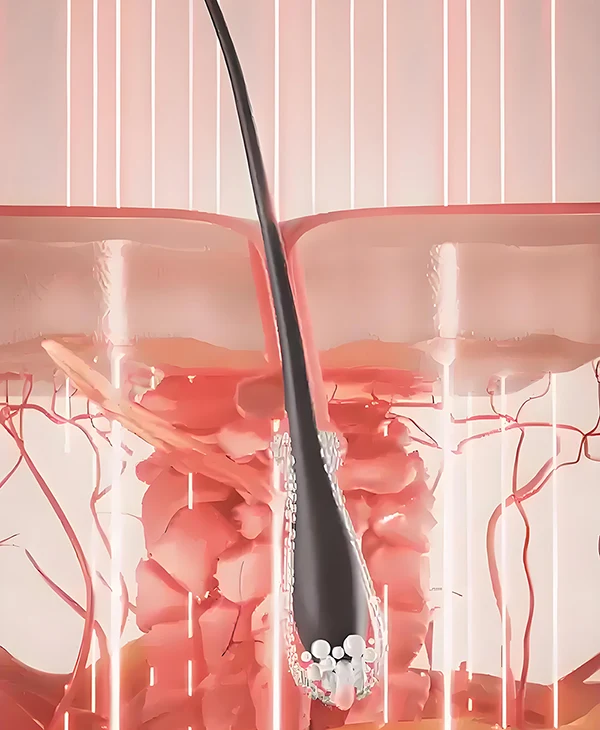 Wie niedrige Lasertherapie auf niedriger Ebene (Lllt) Fördert das Haarwachstum